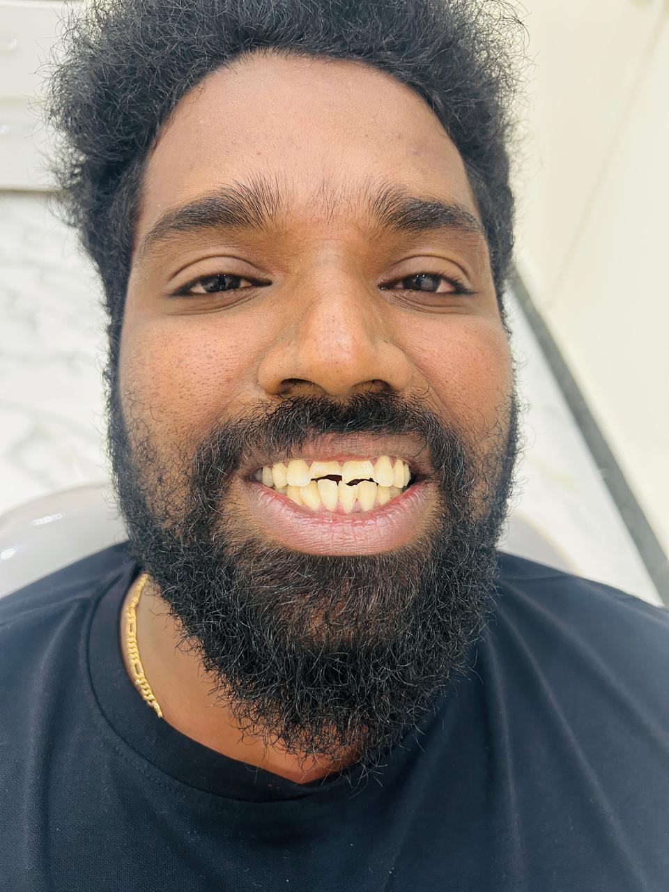 fractured discoloured front tooth after a road traffic accident