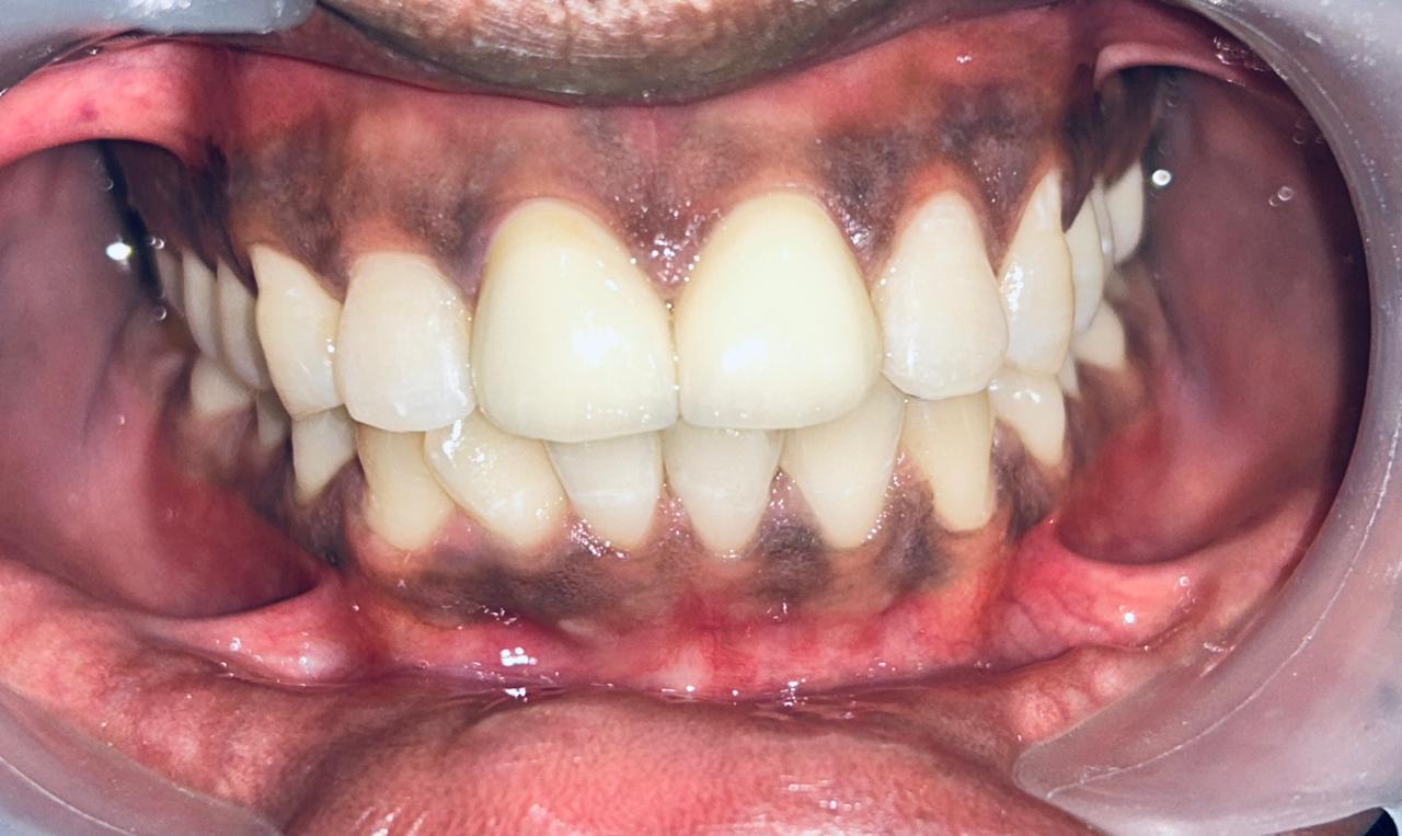 close-up of the same front tooth restored with a shade-matched crown